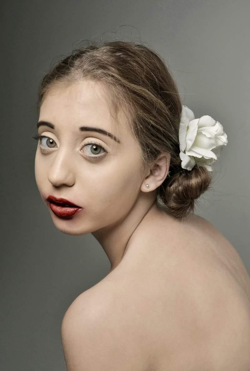 Prosthetic Application